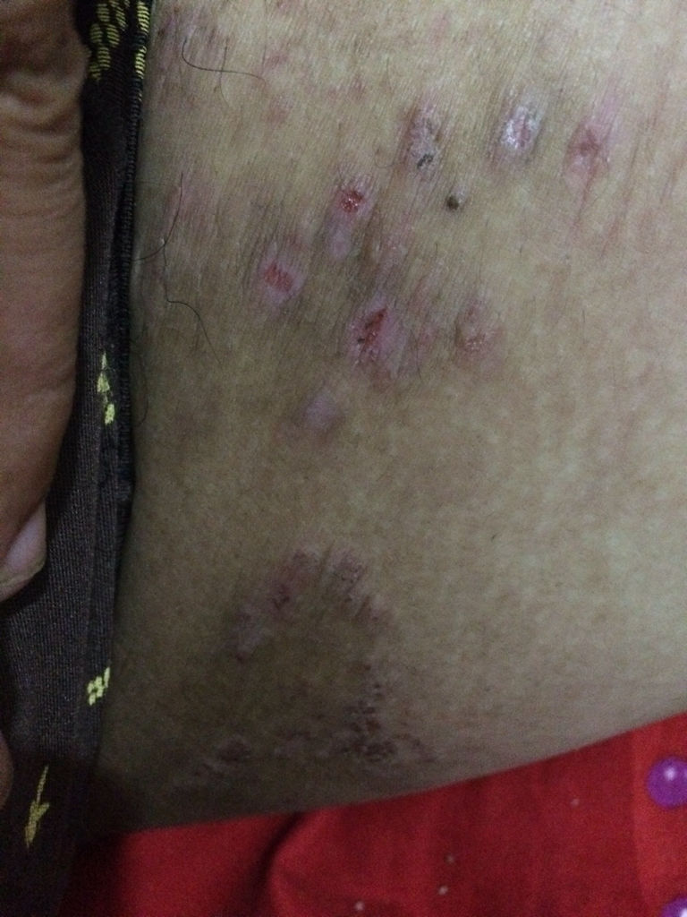 大腿根部很痒还有包,大腿根部很痒还有包怎么回事